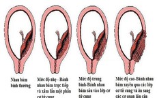 Thận trọng với nhau cài răng lược khi mang thai