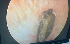 Bị rết sống chui vào tai, người đàn ông 33 tuổi ở Ninh Bình đau đớn nhập viện