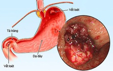 Áp lực mùa thi, nam sinh 15 tuổi hai lần nhập viện vì loét dạ dày