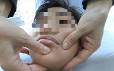 Miền Bắc rét đột ngột, gia tăng số người bị méo miệng