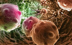 Tế bào ung thư khởi phát từ đâu? Người Việt cần chủ động hơn để phòng bệnh