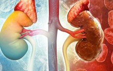 Đừng đợi đến khi chạy thận mới hối hận: 5 tín hiệu 'cầu cứu' từ thận bị 90% người bệnh bỏ qua