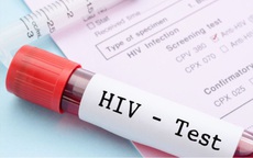 Đi khám vì đau họng dai dẳng, mảng trắng lan nhanh trong miệng, cô gái bất ngờ phát hiện HIV
