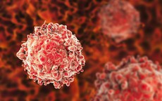 Tế bào ung thư 'thích' nhất 5 vị trí này trên cơ thể, người Việt nên biết để phòng ngừa từ sớm