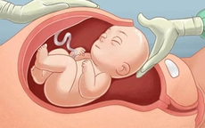 Yếu tố hình thành nhau cài răng lược - mối nguy hiểm trong thai kỳ