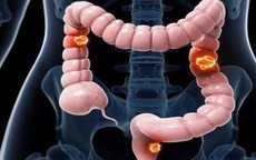Nam sinh viên 22 tuổi mắc ung thư đại tràng giai đoạn 4 thừa nhận bỏ qua 3 dấu hiệu báo bệnh này