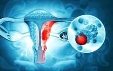 Người phụ nữ 49 tuổi phát hiện ung thư cổ tử cung âm thầm làm 1 điều khiến nhiều người nể phục