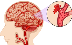 Cô gái 27 tuổi bất ngờ đột quỵ tuyến yên vì chủ quan, bỏ qua dấu hiệu đau đầu kéo dài