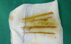 Nuốt tăm khi ăn cỗ cưới, cô gái 26 tuổi nhập viện gấp vì suýt thủng đại tràng