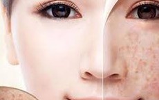 Nhận diện thủ phạm gây đốm đồi mồi trên da