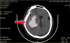 Người đàn ông 44 tuổi đang khỏe mạnh bất ngờ đột quỵ từ dấu hiệu nhiều người Việt mắc phải