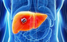 Người đàn ông 44 tuổi phát hiện ung thư gan sau khi xét nghiệm men gan tăng cao: Có 1 thói quen nhiều người Việt mắc phải