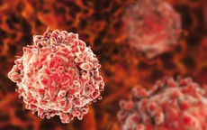 Người đàn ông 65 tuổi phát hiện ung thư dương vật từ dấu hiệu nhiều nam giới Việt bỏ qua