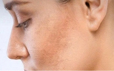 Vì sao da ngày càng sạm màu? Cách lấy lại làn da sáng khỏe