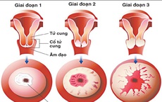 Cô gái 20 tuổi ở Hà Nội đi khám tiền hôn nhân bất ngờ phát hiện tiền ung thư cổ tử cung