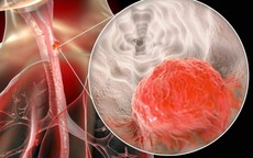 Người đàn ông mắc ung thư thực quản thừa nhận 2 sai lầm nhiều người Việt mắc phải