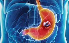 Người phụ nữ 55 tuổi mắc ung thư dạ dày giai đoạn 4 gặp may mắn: Cơ hội điều trị tốt sau ca mổ