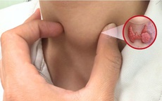 Người phụ nữ phát hiện ung thư tuyến giáp từ dấu hiệu nhiều người Việt bỏ qua