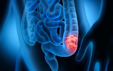 Người phụ nữ 66 tuổi phát hiện ung thư trực tràng từ polyp, thừa nhận 1 sai lầm nhiều người Việt mắc phải