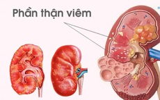 Bé gái 11 tuổi co giật, tăng huyết áp sau viêm họng do biến chứng viêm cầu thận hậu nhiễm liên cầu