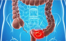 Người đàn ông phát hiện ung thư trực tràng từ dấu hiệu mơ hồ, nhiều người Việt mắc phải đã vô tình bỏ qua