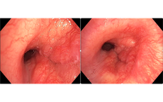 Người đàn ông 32 tuổi phát hiện ung thư phổi hiếm gặp từ dấu hiệu nhiều người Việt mắc phải