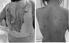 Người phụ nữ 35 tuổi bị tróc da toàn thân thừa nhận 1 sai lầm nhiều người Việt mắc phải