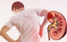 Người đàn ông 35 tuổi mắc suy thận mạn tính từ những món ăn quen thuộc tại hàng quán