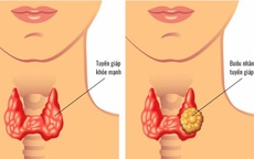 Chủ quan với nhân tuyến giáp, người phụ nữ trẻ đi khám phát hiện 13 hạch di căn