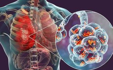 Người đàn ông 67 tuổi ở Hà Nội phát hiện ung thư phổi di căn từ dấu hiệu nhiều người Việt bỏ qua