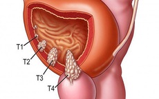 Người đàn ông 57 tuổi phát hiện u bàng quang từ dấu hiệu nhiều người Việt mắc phải nhưng bỏ qua