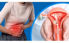 7 dấu hiệu thường gặp của lạc nội mạc tử cung chị em nên chú ý