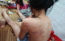 Cao Bằng: Phát hiện con bầm tím khắp người, mẹ sốc khi biết nữ sinh lớp 4 bị nhiều bạn đánh