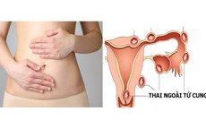 Tưởng rong kinh, người phụ nữ suýt mất mạng vì vỡ thai ngoài tử cung