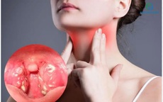 Đau họng kéo dài 3 tuần, người đàn ông 60 tuổi đi khám phát hiện ung thư amidan giai đoạn 4