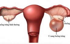 Phát hiện u buồng trứng khổng lồ sau 2 năm bỏ tái khám, người phụ nữ 68 tuổi thừa nhận sai lầm nhiều chị em mắc phải