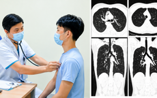 Nam thanh niên 20 tuổi tràn khí trung thất sau 1 tuần ho liên tục, bác sĩ cảnh báo dấu hiệu dễ bị bỏ qua