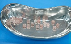 Người đàn ông 34 tuổi viêm dương vật, bác sĩ phát hiện 20 viên thủy tinh dưới da