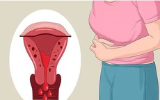 Người phụ nữ 53 tuổi thiếu máu nặng vì chủ quan với u xơ tử cung
