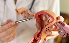 Polyp nội mạc tử cung có nguy hiểm không?