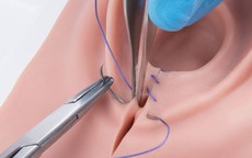 Thẩm mỹ vùng kín, chị em cần biết 4 điều để tránh biến chứng