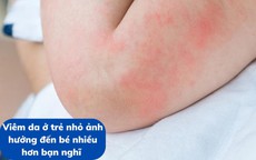 Viêm da ở trẻ nhỏ ảnh hưởng đến bé nhiều hơn bạn nghĩ