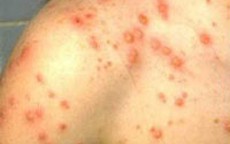 Bệnh thuỷ đậu: Không nên dùng rạ để tắm hoặc đắp lá