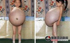 Bé gái 4 tuổi có "bụng bầu" khổng lồ