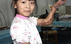 Bé gái 9 tuổi được ghép tay vào chân