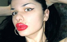 Đôi môi 'siêu khủng' của cô gái nghiện bơm silicone 