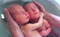 Bé sinh đôi ôm chặt nhau không rời sau khi chào đời