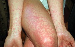 Người lớn mắc sởi khó phát hiện