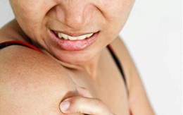 Cách trị bệnh dị ứng mề đay
