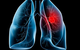 Thử nghiệm mới chống ung thư phổi giảm 43% nguy cơ tử vong